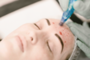 VTCT (ITEC) Level 4 Certificate in Skin Needling